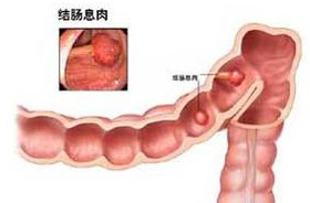 息肉