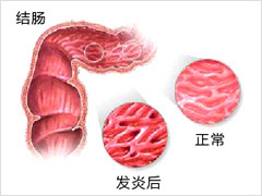 结肠炎