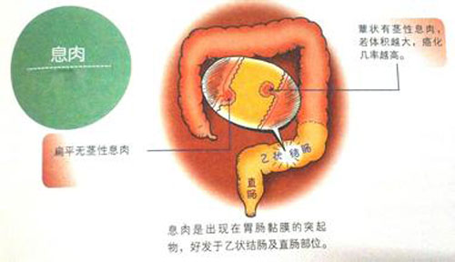 息肉图