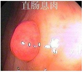 直肠息肉