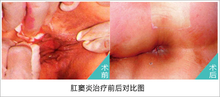 肛窦炎治疗前后对比图