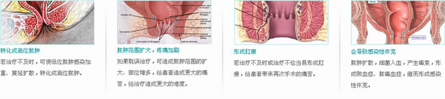 肛周脓肿