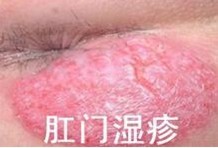 肛门湿疹