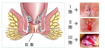 肛裂发展图