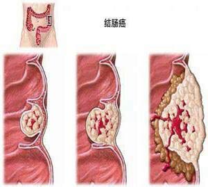 肠liu