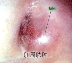 肛周脓肿