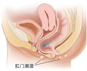 肛门潮湿