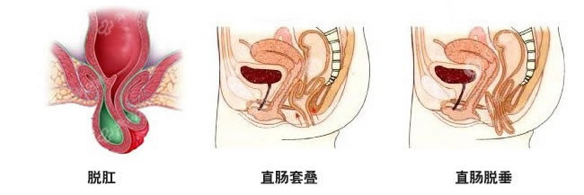 脱肛手术费用
