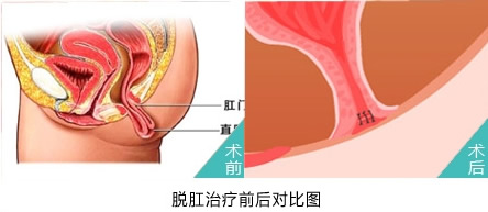 脱肛治疗对比