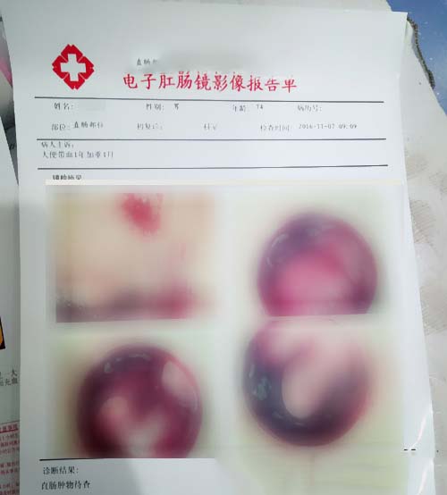 电子肛肠镜检查