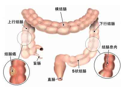结肠liu