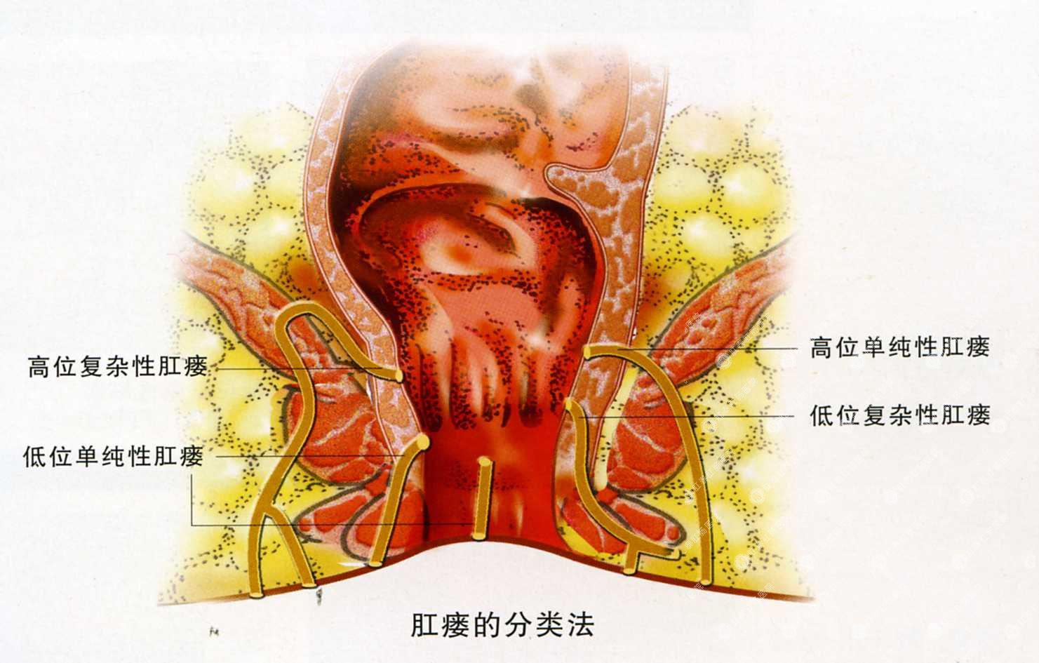 低位单纯性肛瘘