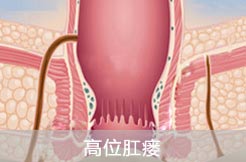 高位复杂性肛瘘