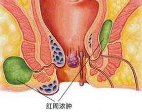 高位肛周脓肿
