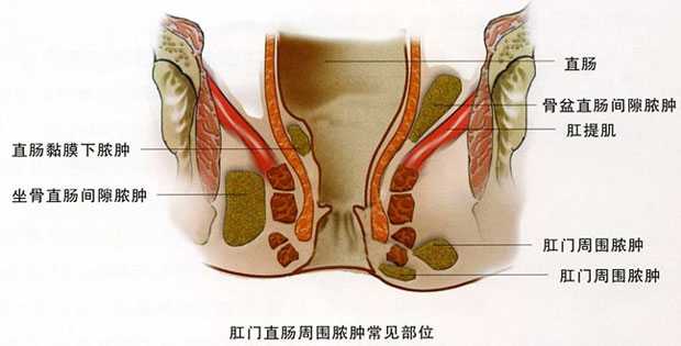 低位肛周脓肿